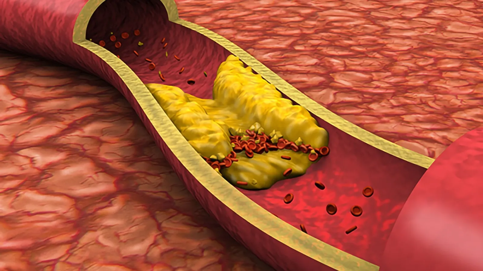 Recommandations sur le cholestérol LDL, statines et nouvelles cibles thérapeutiques