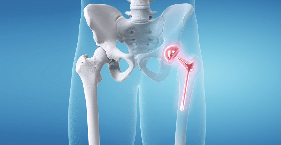 Hip Replacement Surgery